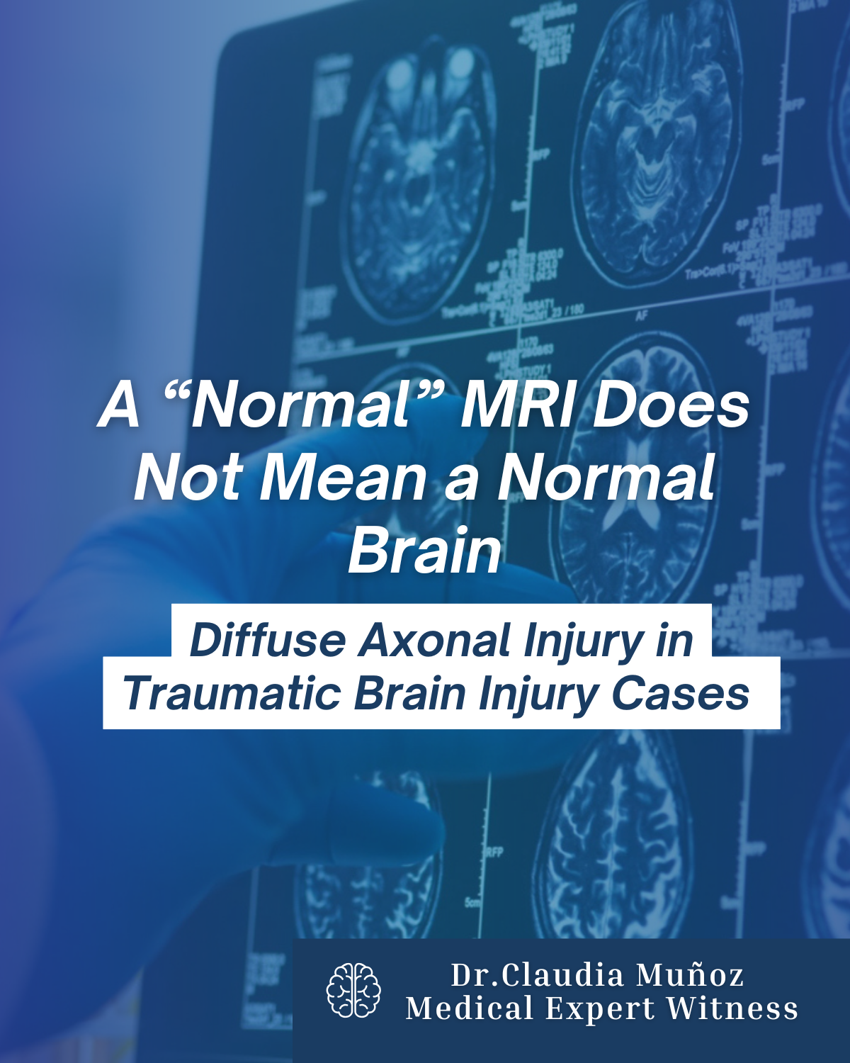 A “Normal” MRI Does Not Mean a Normal Brain Diffuse Axonal Injury in Traumatic Brain Injury Cases&nbsp;