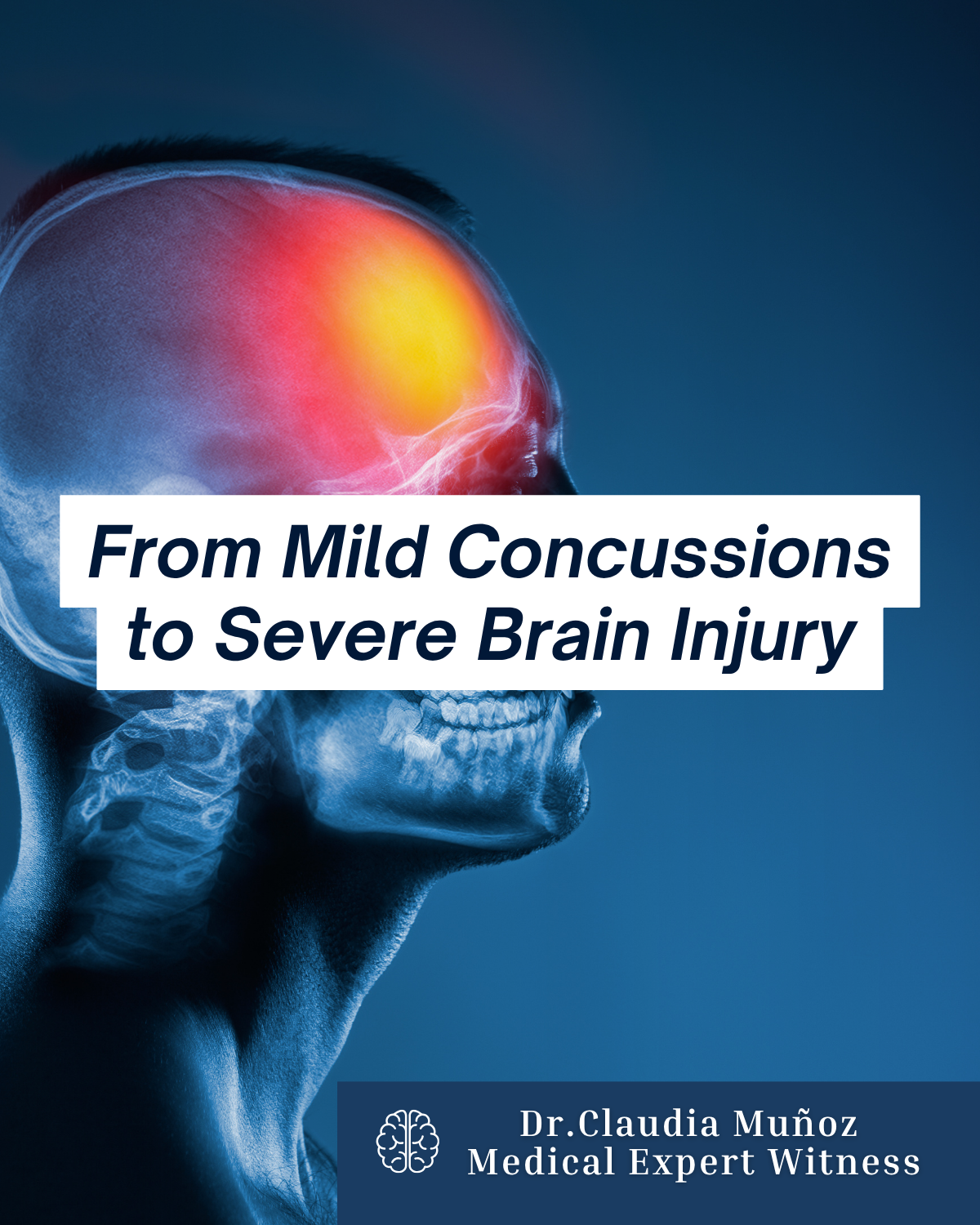 TBI Explained: From Mild Concussions to Severe Brain Injury