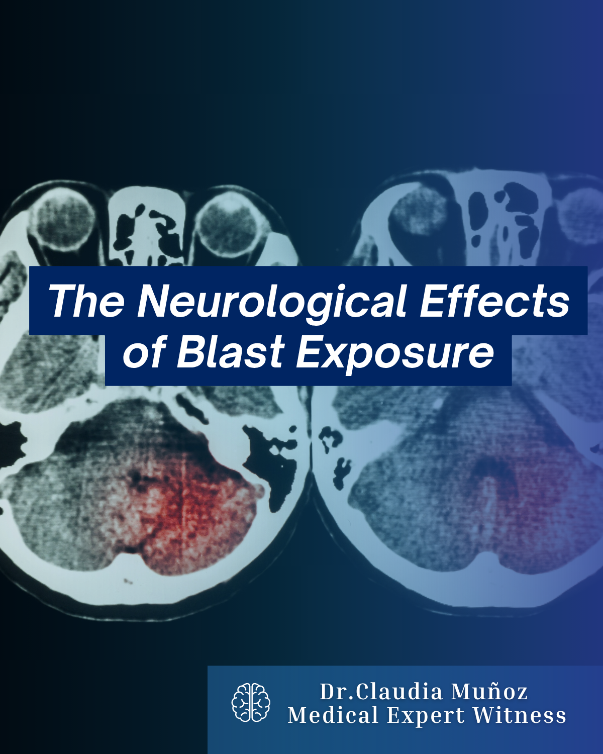 The Neurological Effects of Blast Exposure