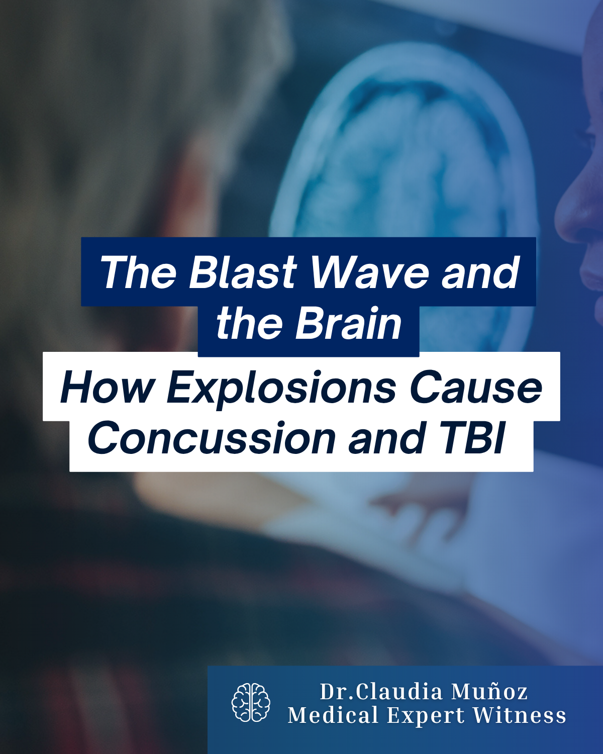 The Blast Wave and the Brain: How Explosions Cause Concussion and TBI