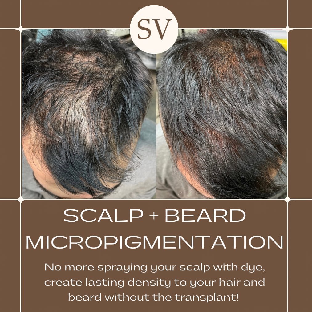 WHAT IS SCALP AND BEARD MICROPIGMENTATION ?!🧔🏻&zwj;♂️🧔🏽&zwj;♂️🧔🏿&zwj;♂️

SMP or Scalp &amp; Hairline and Beard Micro-pigmentation gives the facade of denser hair for both men and women. The technique involves creating the appearance of tiny hai