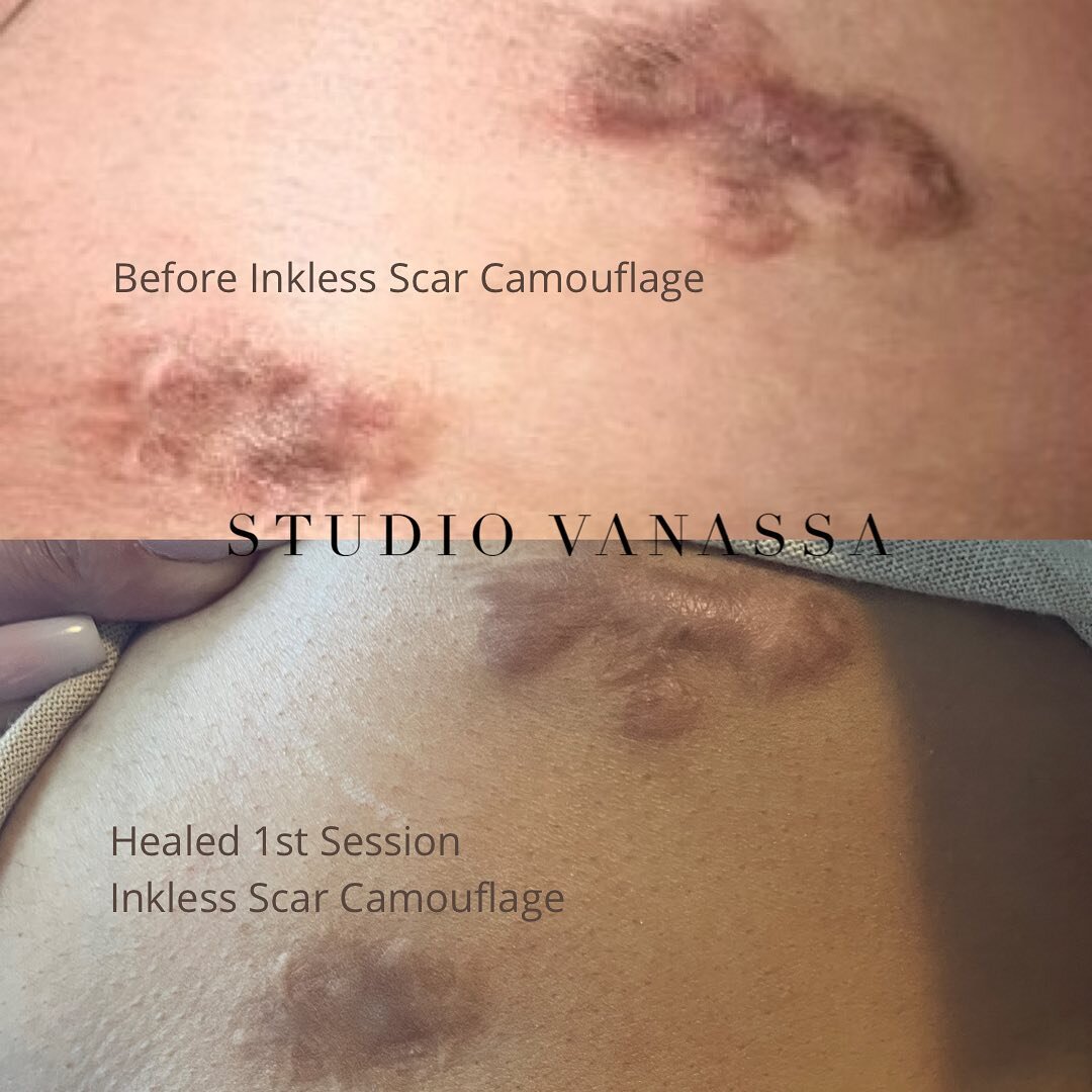 🏎 Scars from an ATV Accident 

My client was very insecure about the reminder these scars represented for her. 

Although risen scars such as these are difficult to treat, these are healed results from our 1ST SESSION of Inkless Scar Camouflage. I u