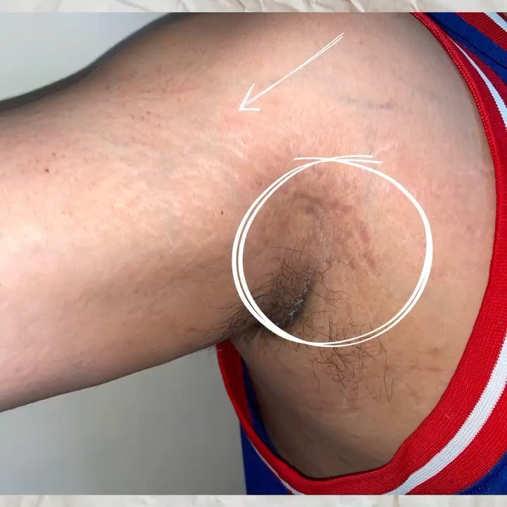 Are you concerned with putting
ink in your skin? If yes, our INKLESS treatment is perfect for you!

This patient had a dramatic improvement in one stretchmarks treatment. Stretchmarks are normal, and most of us have them. They can be caused by change