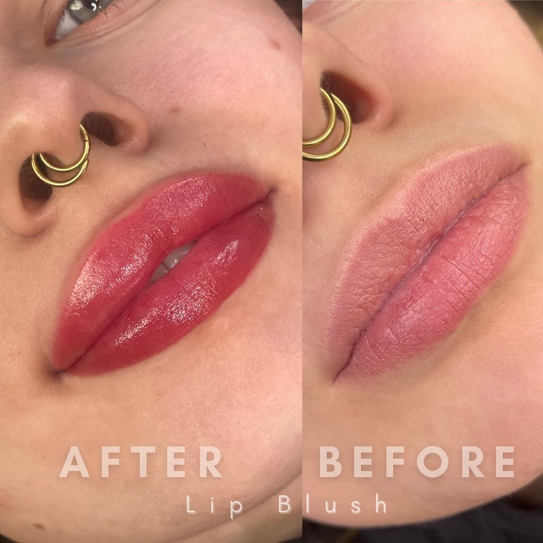 Reshaped and Vibrant Lips! 👄 

My client wanted Nicola Peltz&rsquo;s lips. 
We reshaped her cupids bow and lower lip for a fuller appearance. 
We also brought more colour to her lips for a more youthful look! 
Loss of colour to the lips is a natural