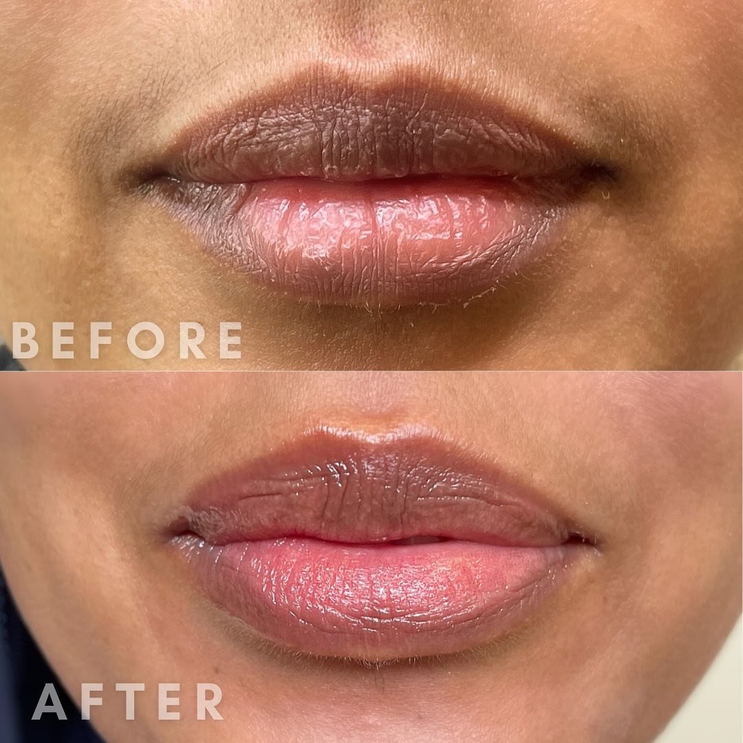 Healed 1st Session 👄

Healed 1st session of Dark lip neutralization. My client thought her lips were small but the extra melanin in her lips made them appear that way. She always wore bright lipstick to conceal the darkness. 
After her complimentary