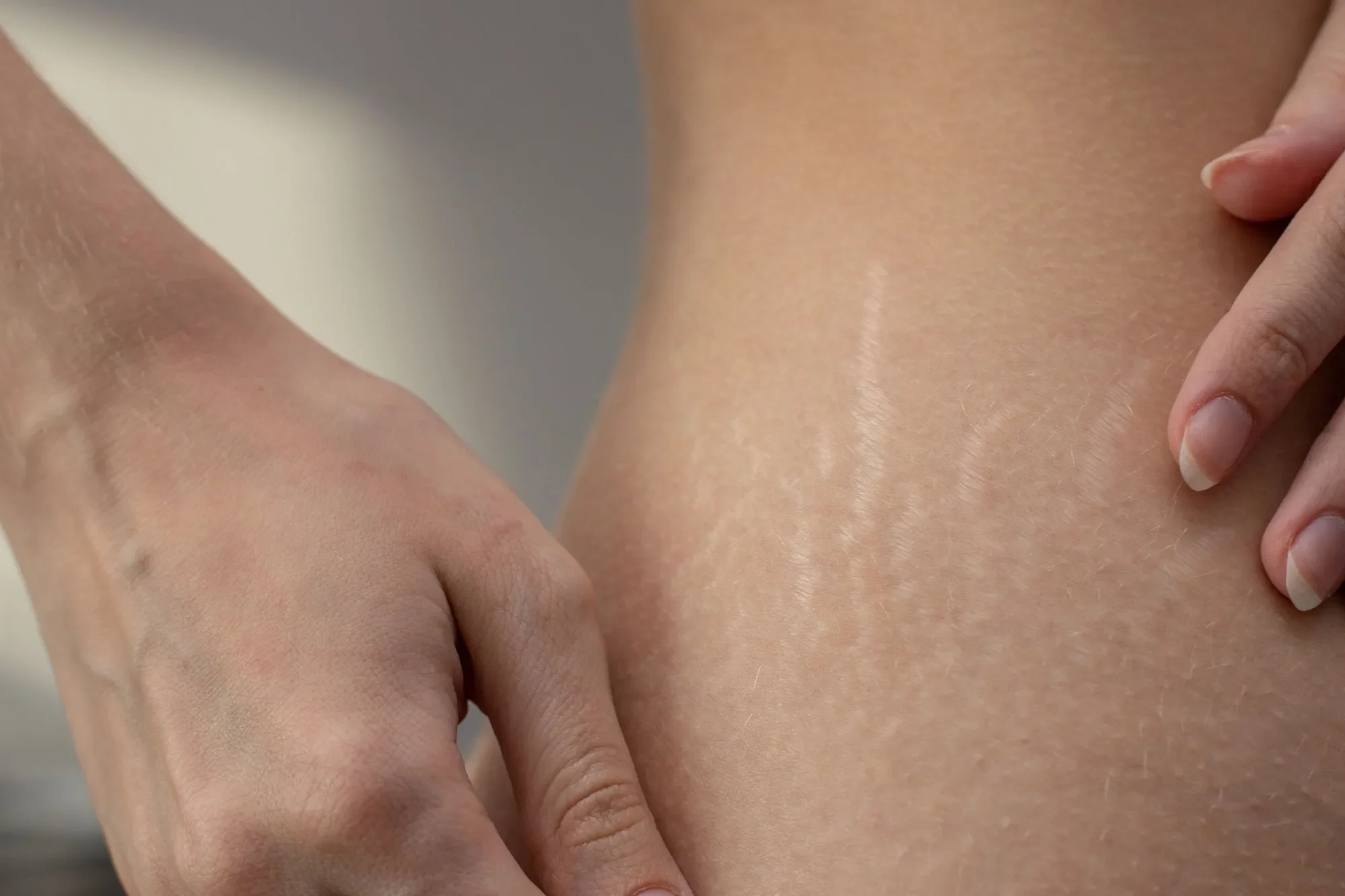 Paramedical Tattooing For Stretch Marks: Does It Work