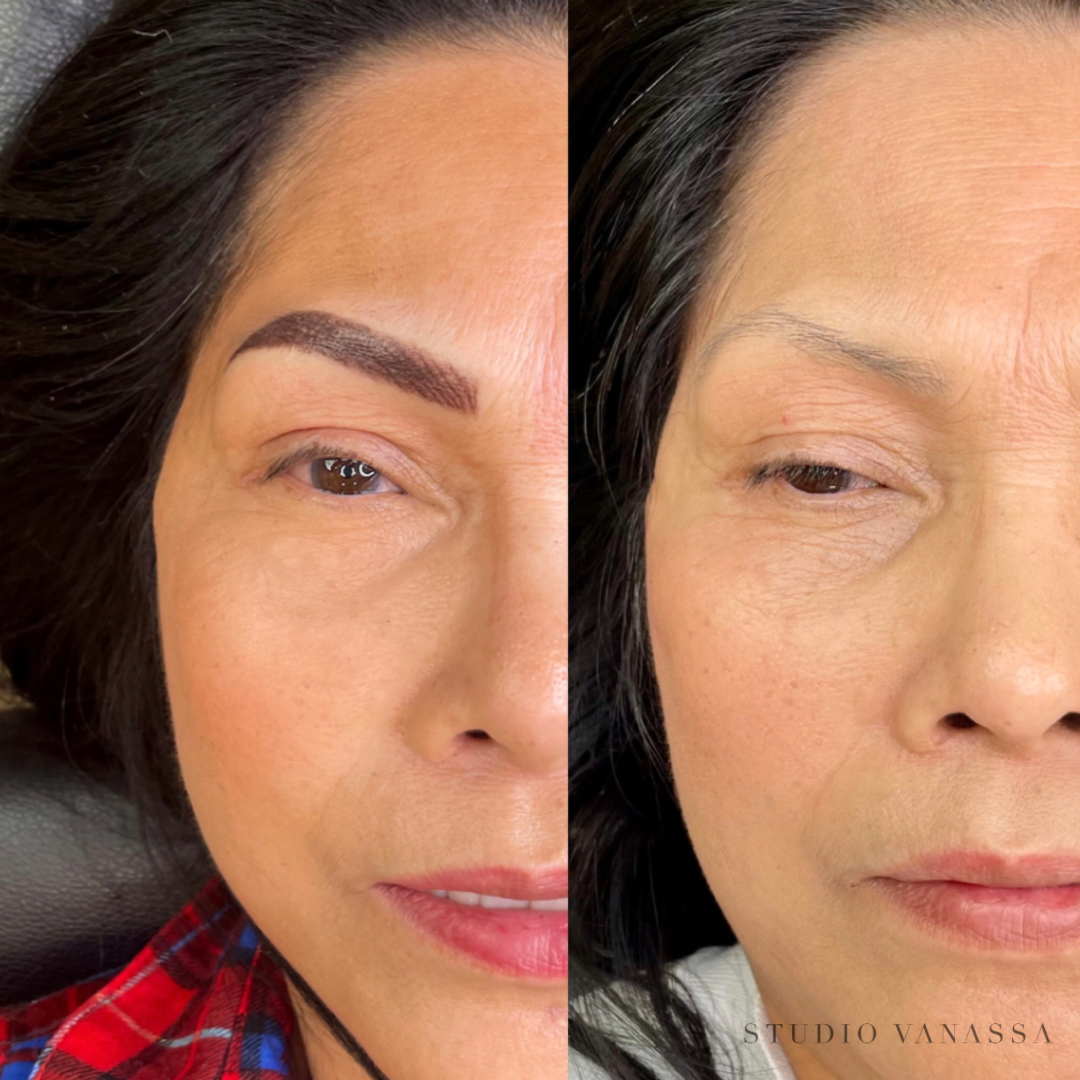 After and before of combo brows treatment