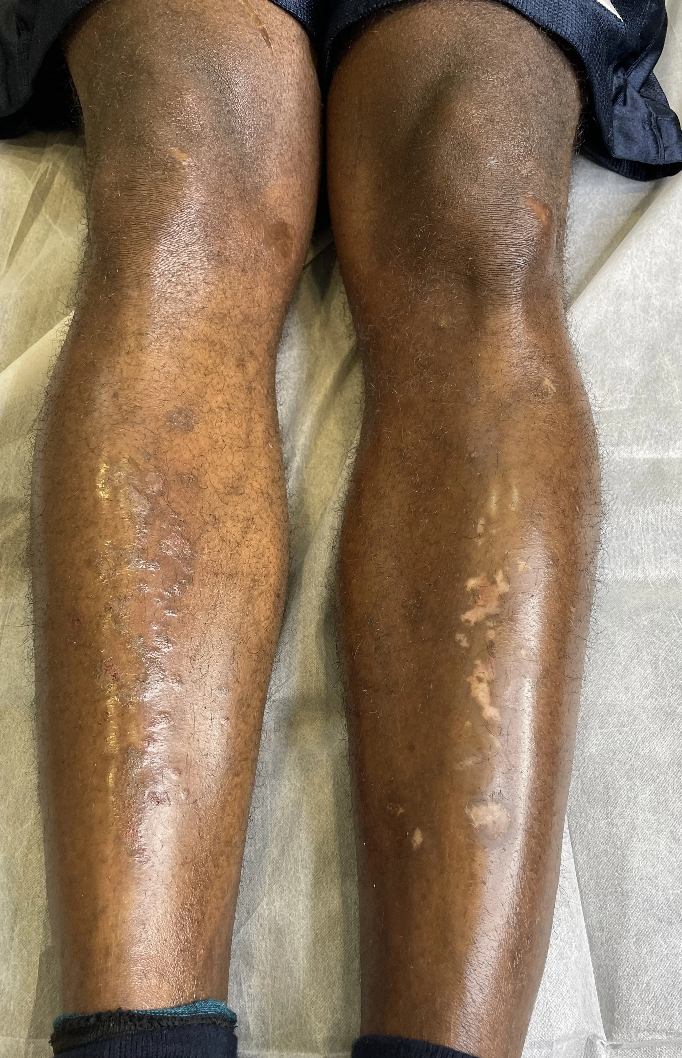 Best Skin and Scar Camouflage Tattoo in Edmonton, Alberta at Studio Vanassa on Whyte Ave