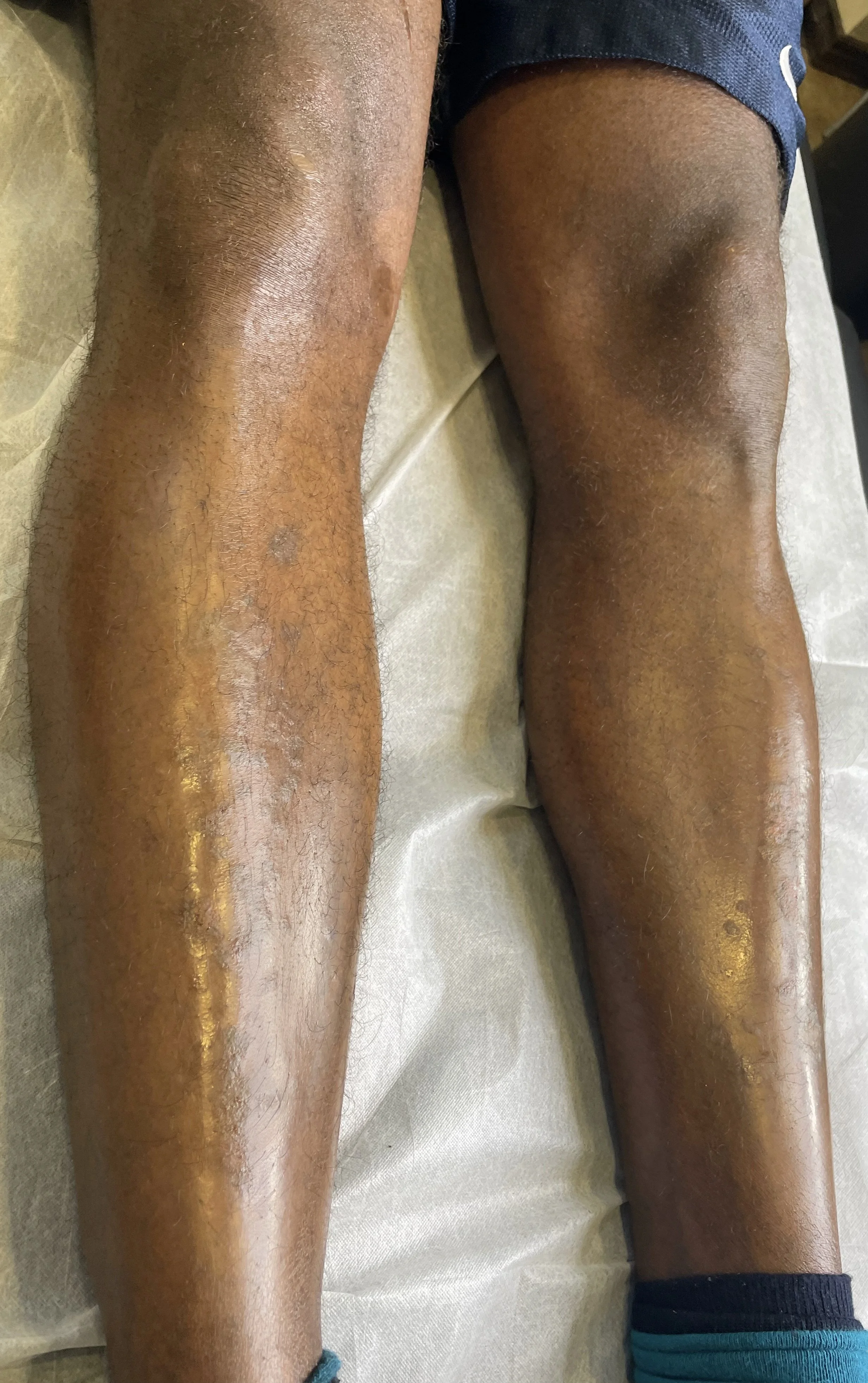 Best Skin and Scar Camouflage Tattoo in Edmonton, Alberta at Studio Vanassa on Whyte Ave