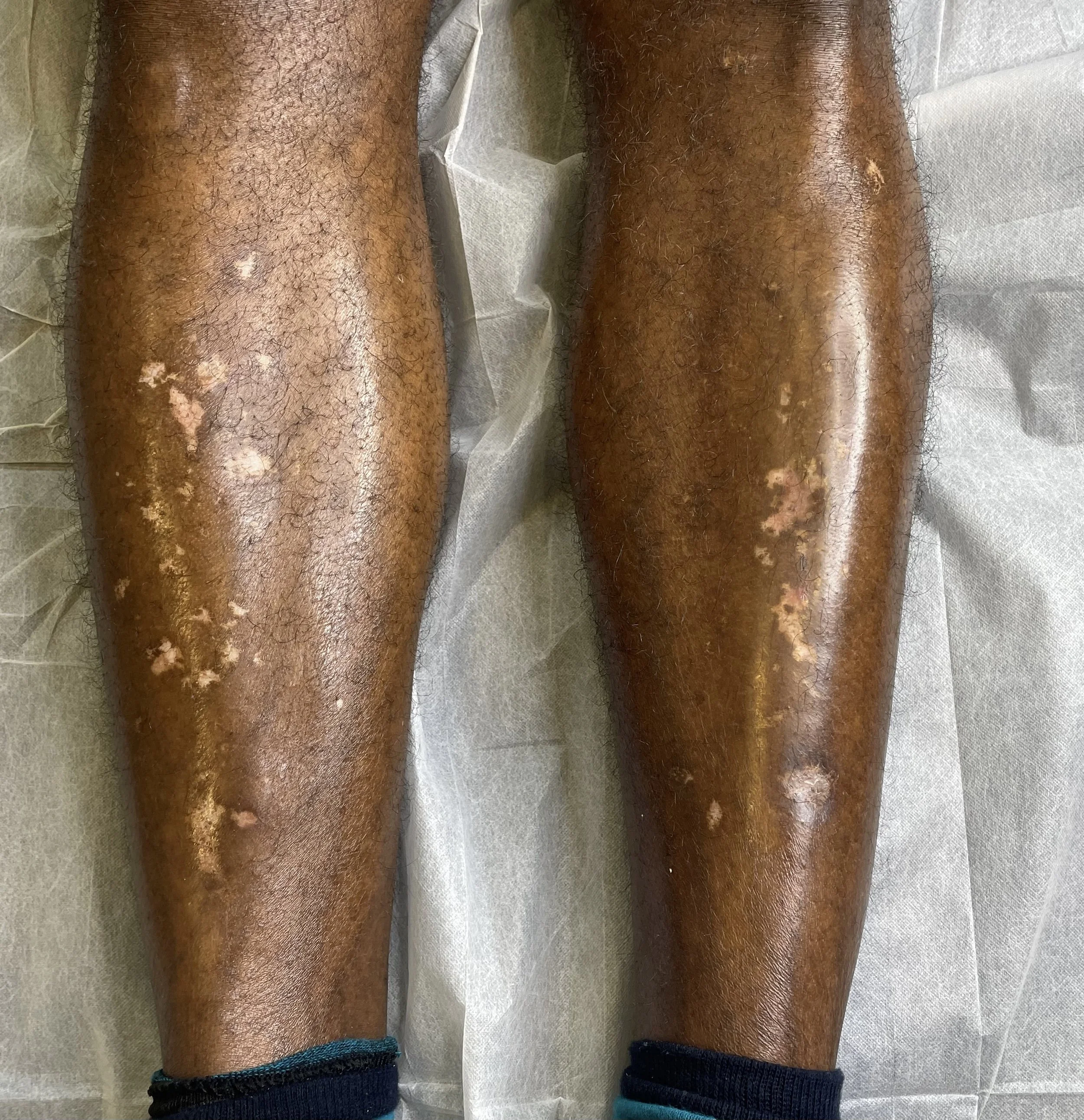 Best Skin and Scar Camouflage Tattoo in Edmonton, Alberta at Studio Vanassa on Whyte Ave