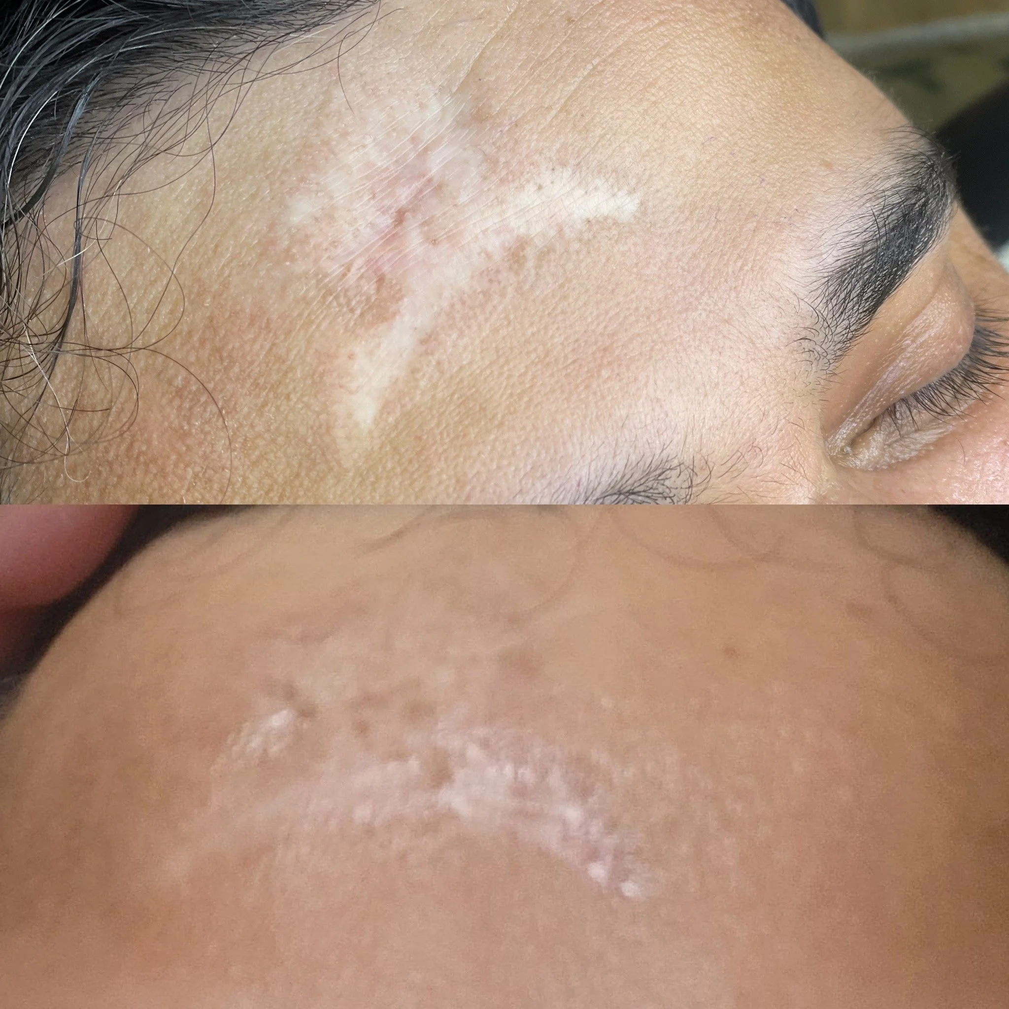 Best Skin and Scar Camouflage Tattoo in Edmonton, Alberta at Studio Vanassa on Whyte Ave