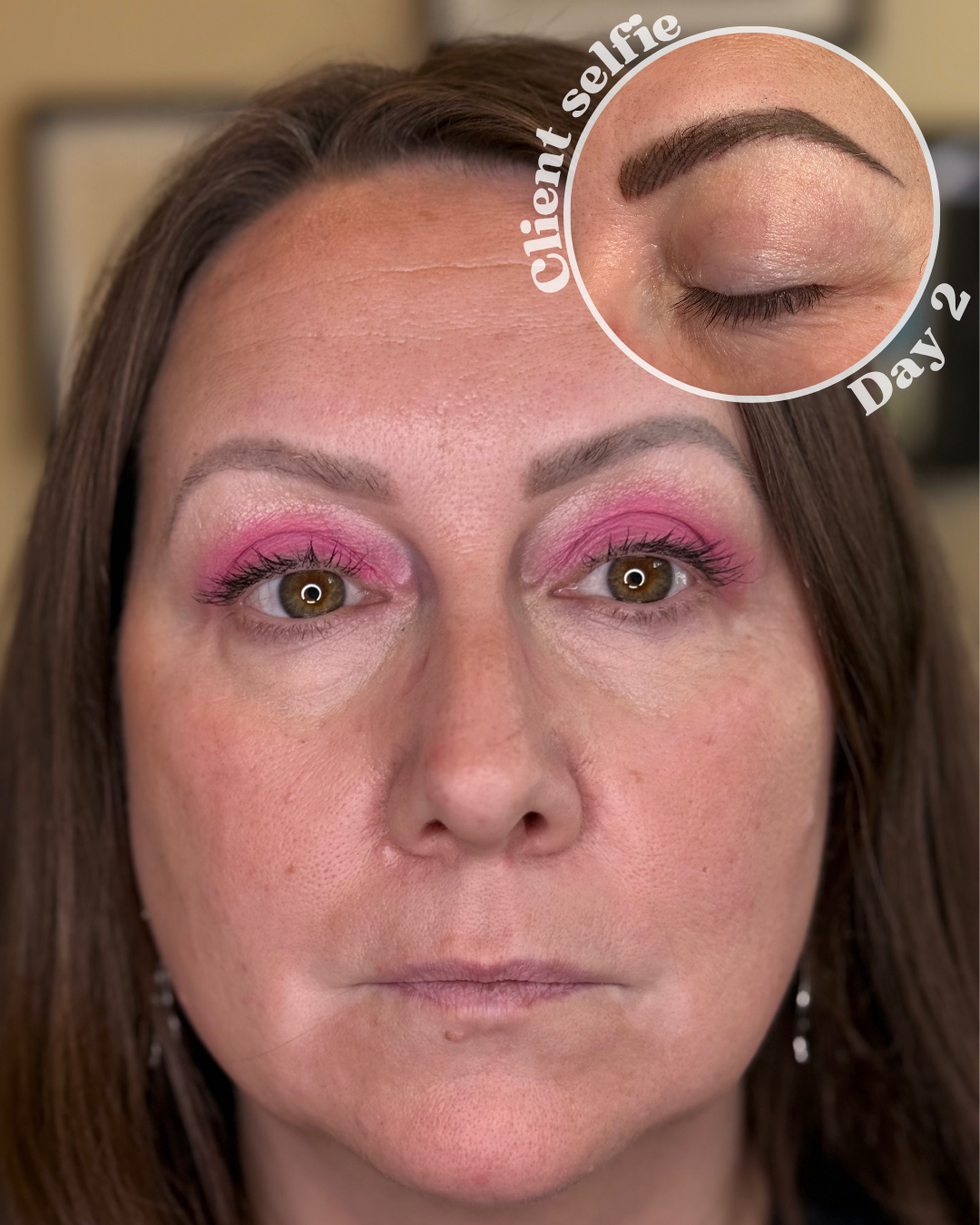 Brow correction results 2 days post procedure