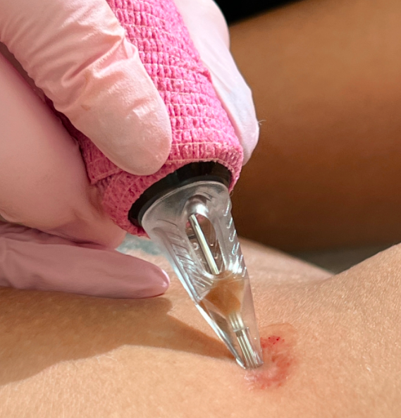 Inkless stretch mark camouflage being performed