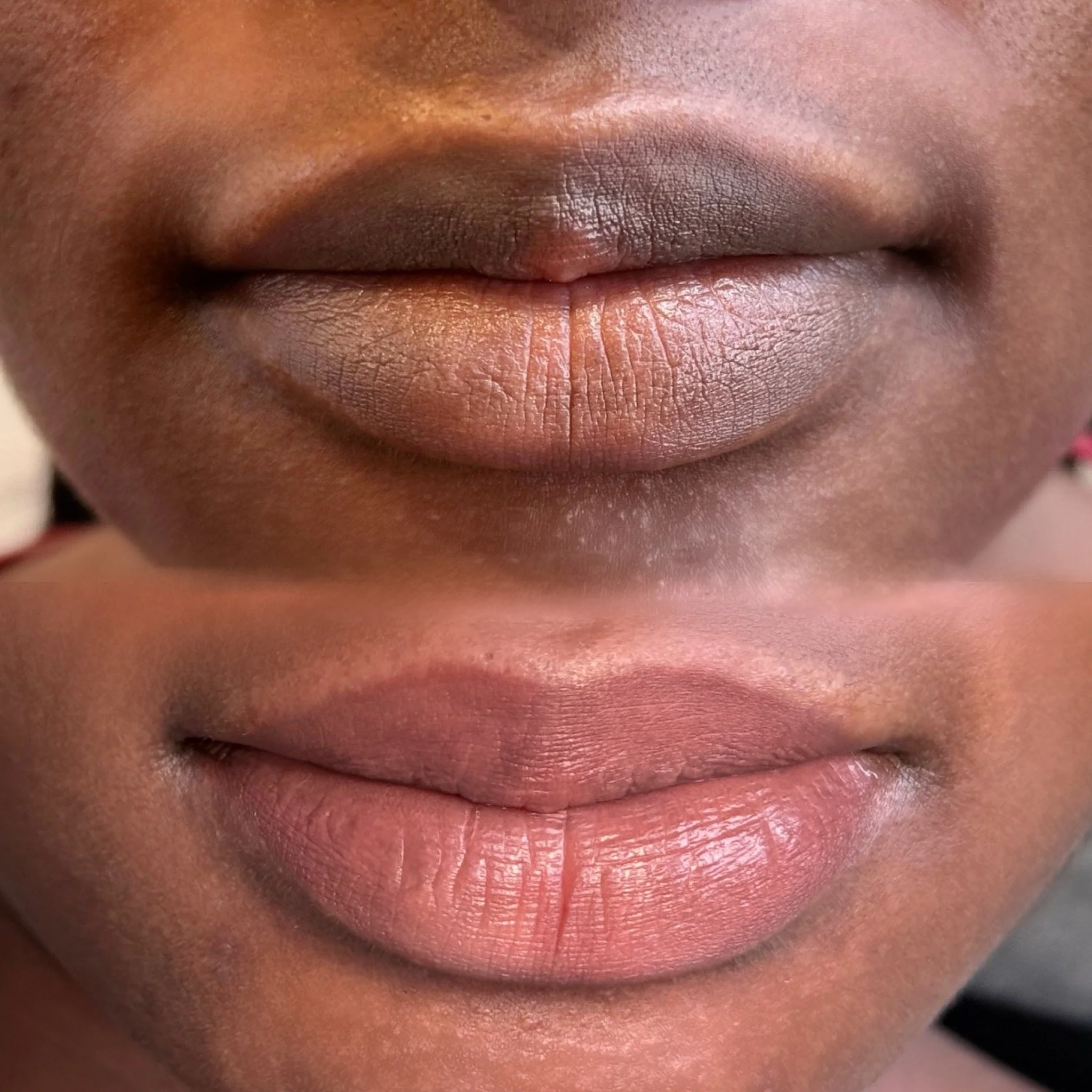 Before and after dark lip neutralization showing darker lip pigmentation softened to more even pink tone at Studio Vanassa in Edmonton