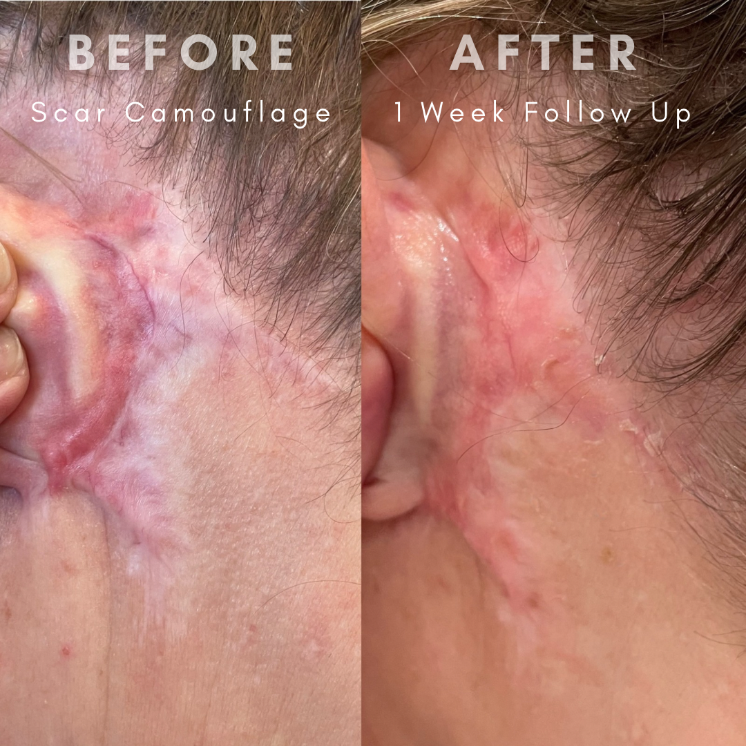 Close-up of a person's cheek and ear showing scar camouflage treatment. The left side is labeled 'BEFORE' with visible scars, and the right side is labeled 'AFTER' showing reduced appearance of scars after one week follow-up.