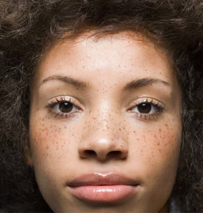 faux freckle results