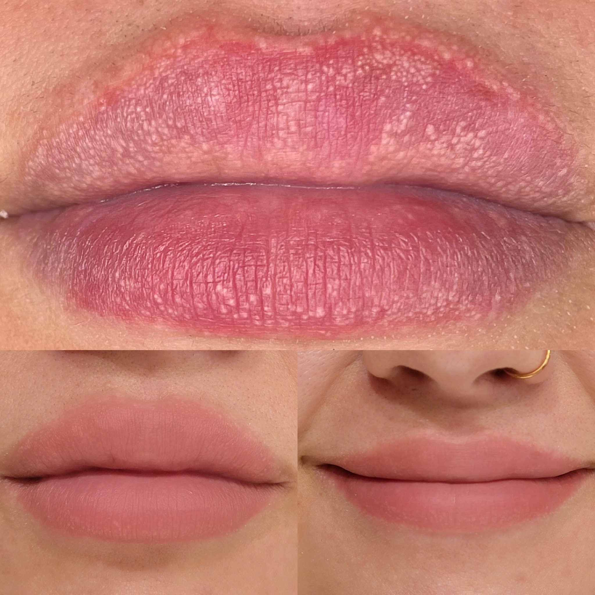 Get Rid Of Fordyce Spots On Lips Reddit Infoupdate get-rid-of-fordyce-spots-on-lips-reddit-infoupdate