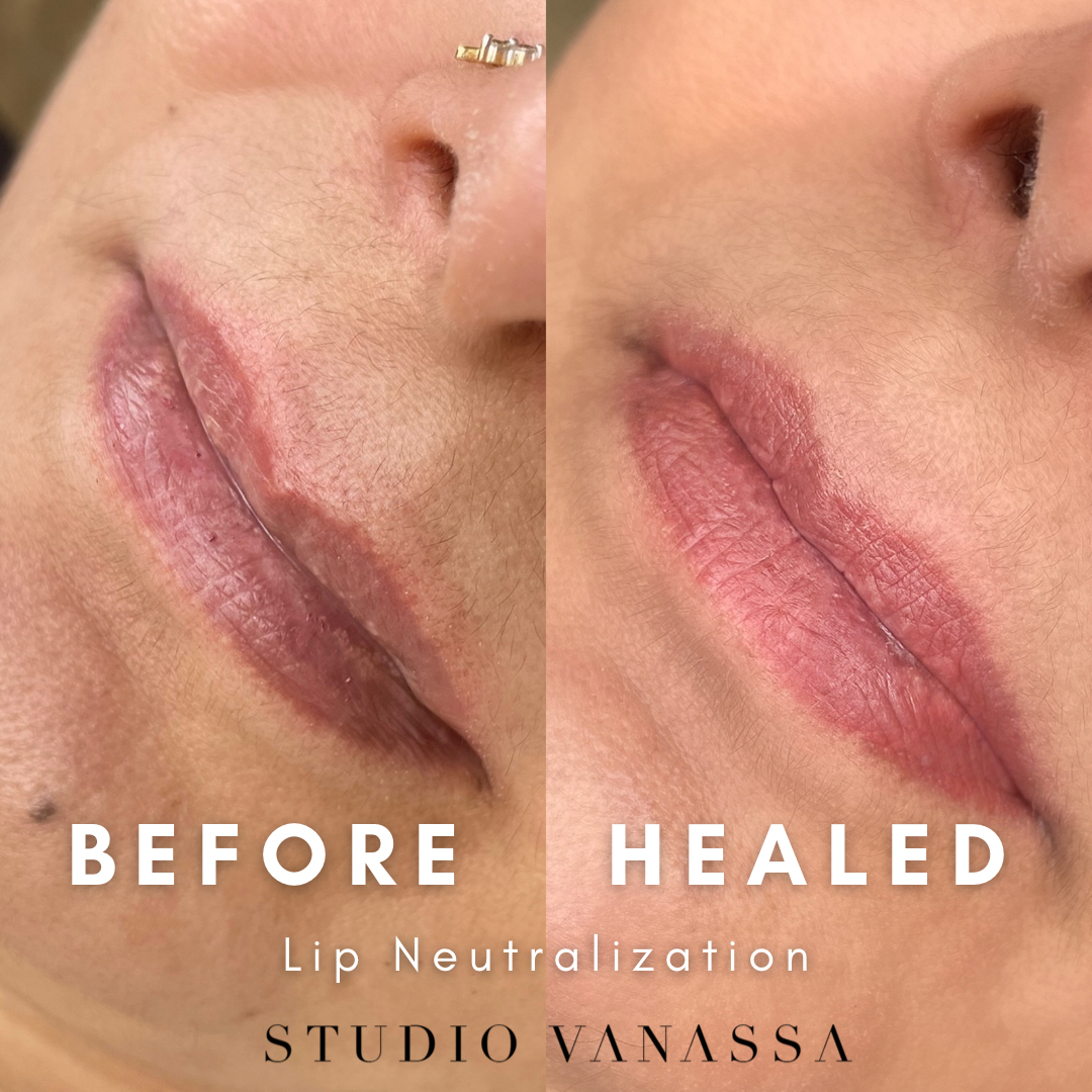 Lip neutralization before and after