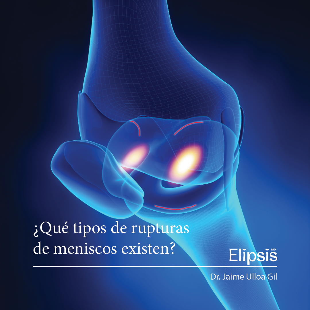 ¿QUÉ TIPOS DE RUPTURAS DE MENISCOS EXISTEN?
