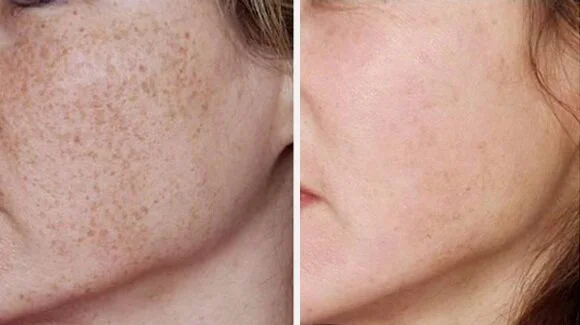ipl-sun-damage-sun-spots-before-after-urban-allure-oakland