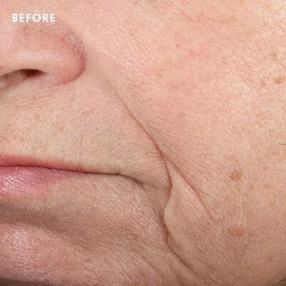 Triple-Lipid-Restore-Before-SkinCeuticals BEFORE.jpg