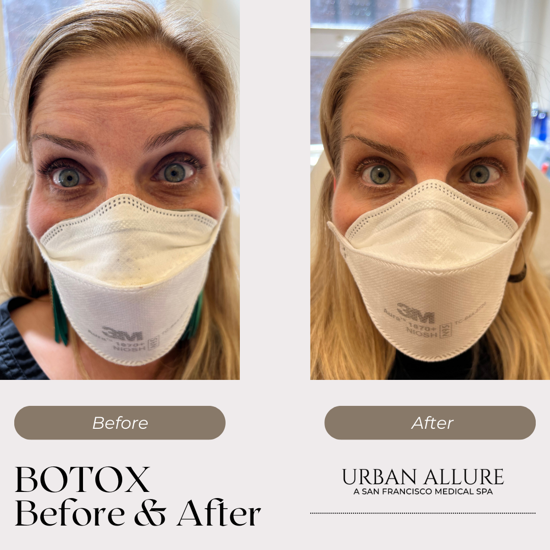 botox-forehead-lines-before-after-urban-allure-oakland