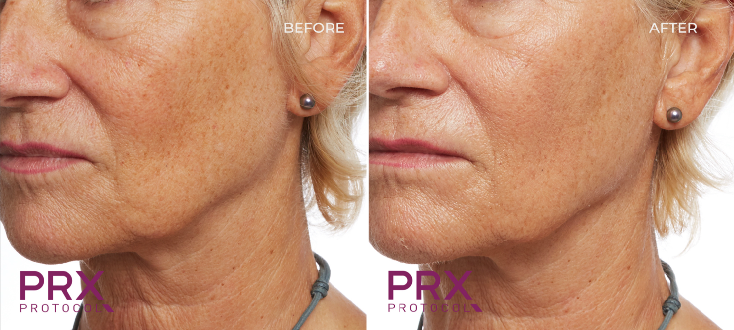 Close-up showing a woman's face before and after skin treatment, highlighting reduced wrinkles and improved skin texture.