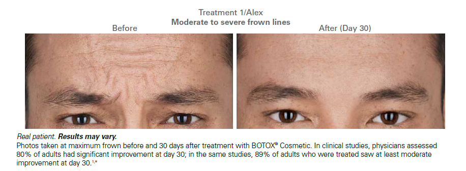 daxxify-before-after-results-urban-allure-oakland-ca