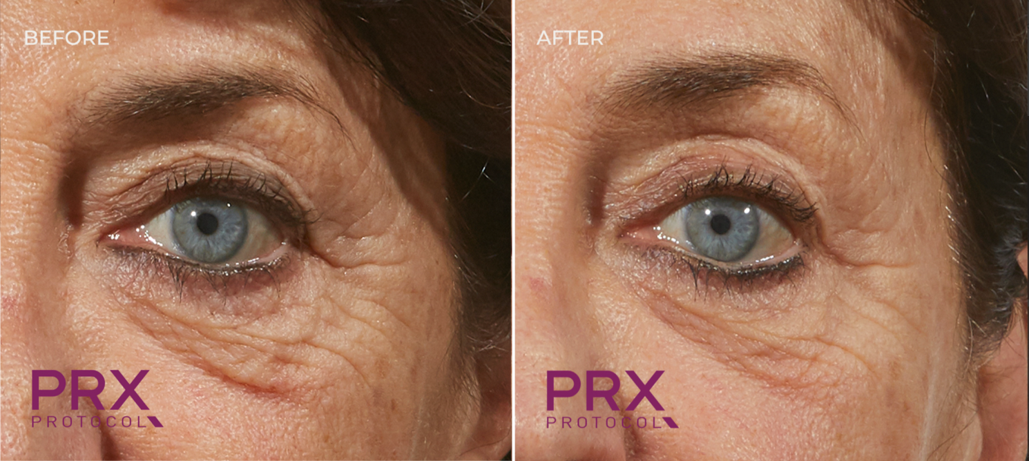 Comparison of a woman's eye area before and after treatment, showing reduced wrinkles and improved skin appearance.