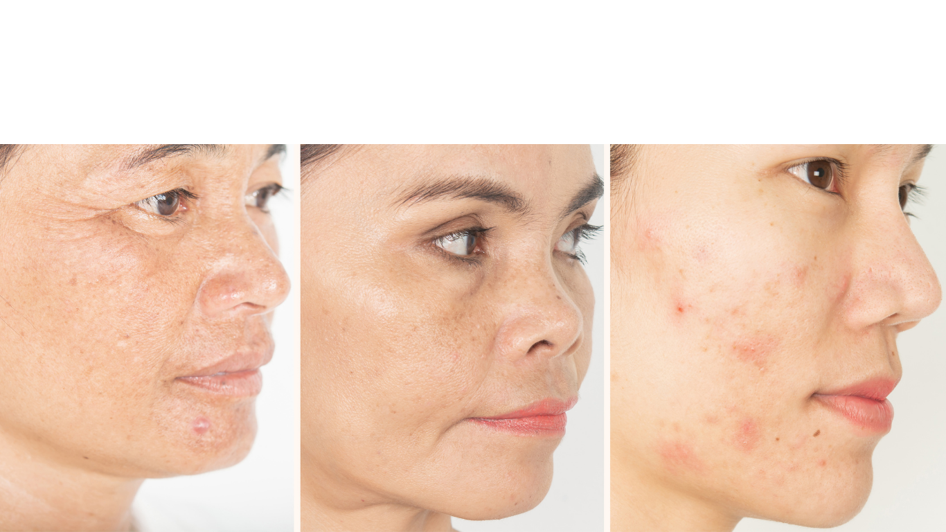 photo-facial-ipl-before-after-urban-allure-oakland-ca