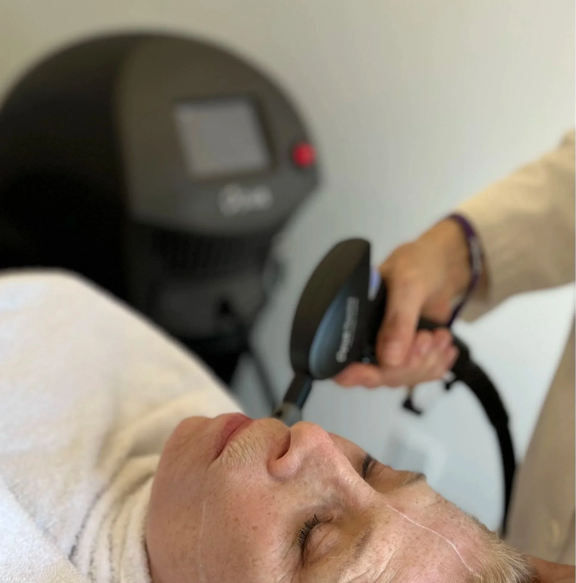 Patient receiving opus plasma treatment at Thornbury Leg Vein Clinic