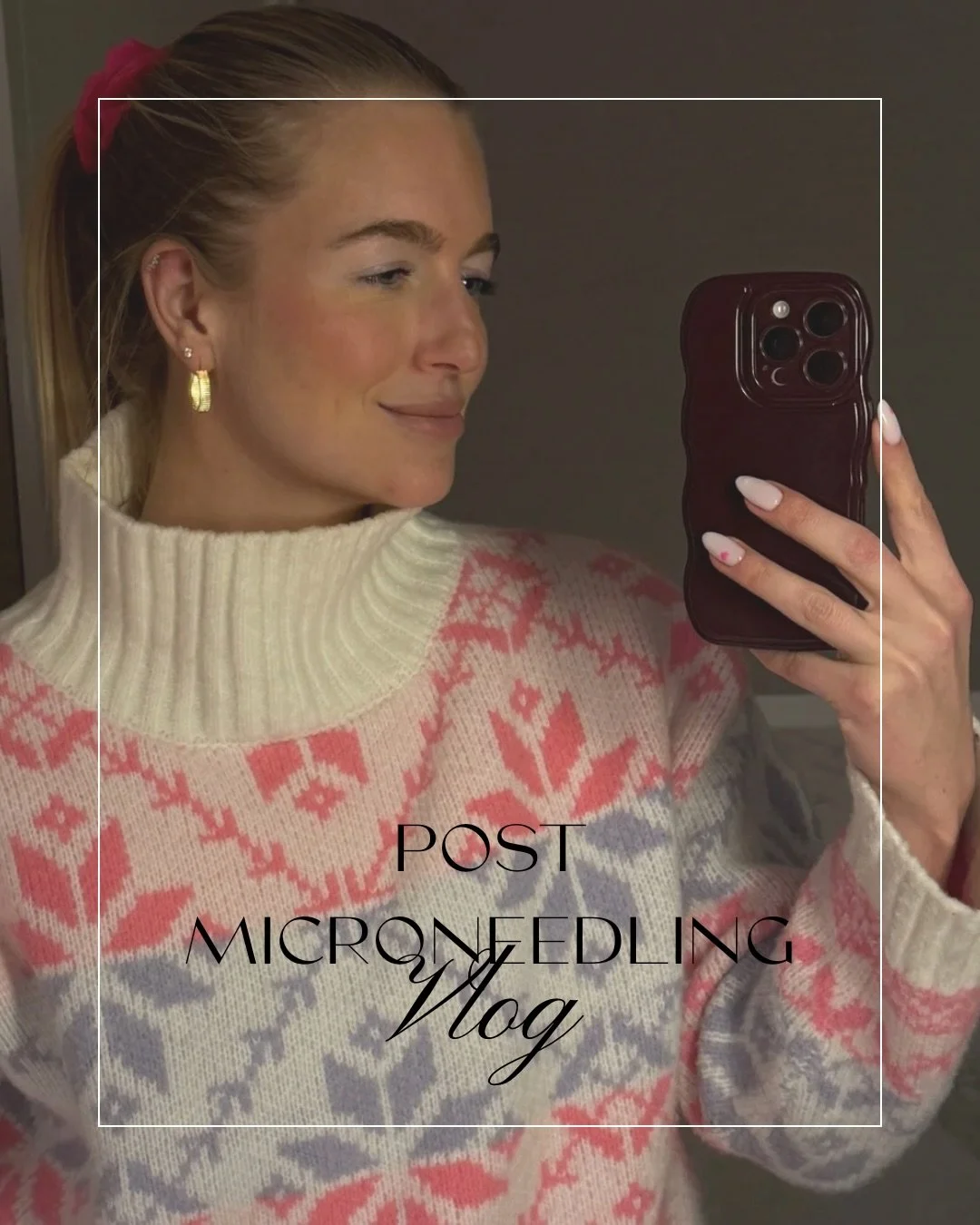 VLOG: Post micro needling treatment 

As I&rsquo;ve previously shared, I&rsquo;m 40 years old and up until two weeks ago I had never tried micro needling! 
(I know 🙈)

Since it was my first time AND since both @d2medspa and @dermetics are so committ