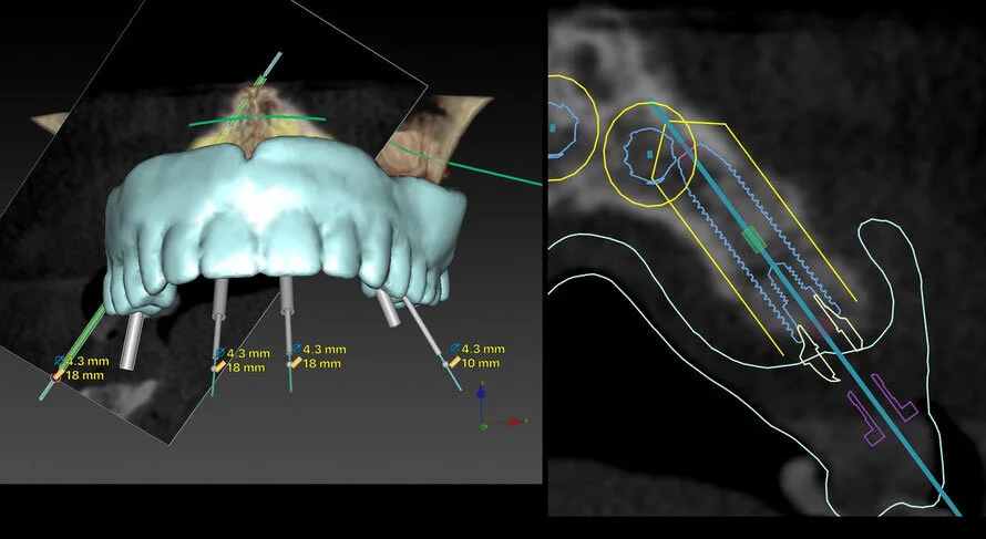 Digitale 3D-planning van een implantaatbehandeling