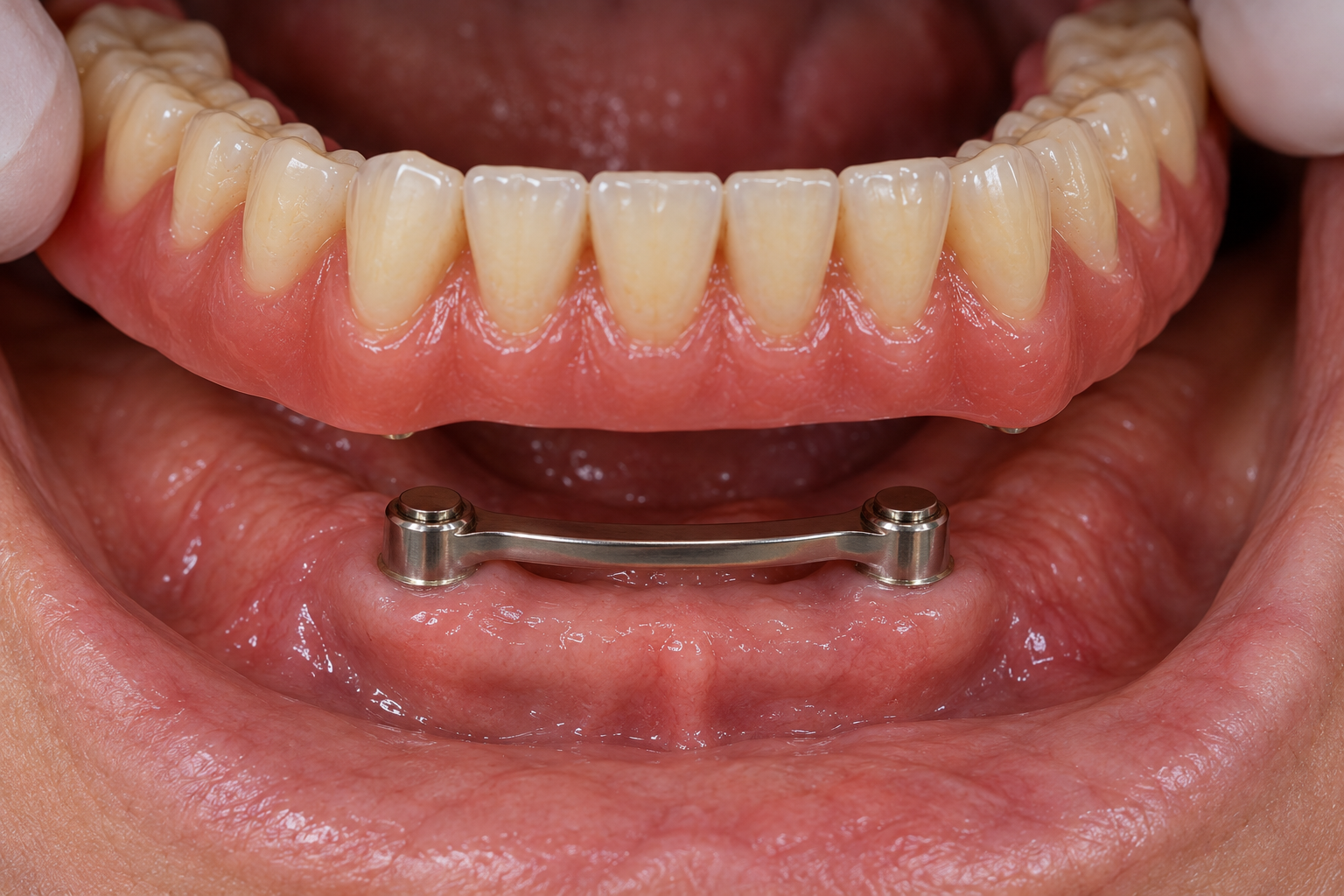 Klikprothese verankerd op implantaten