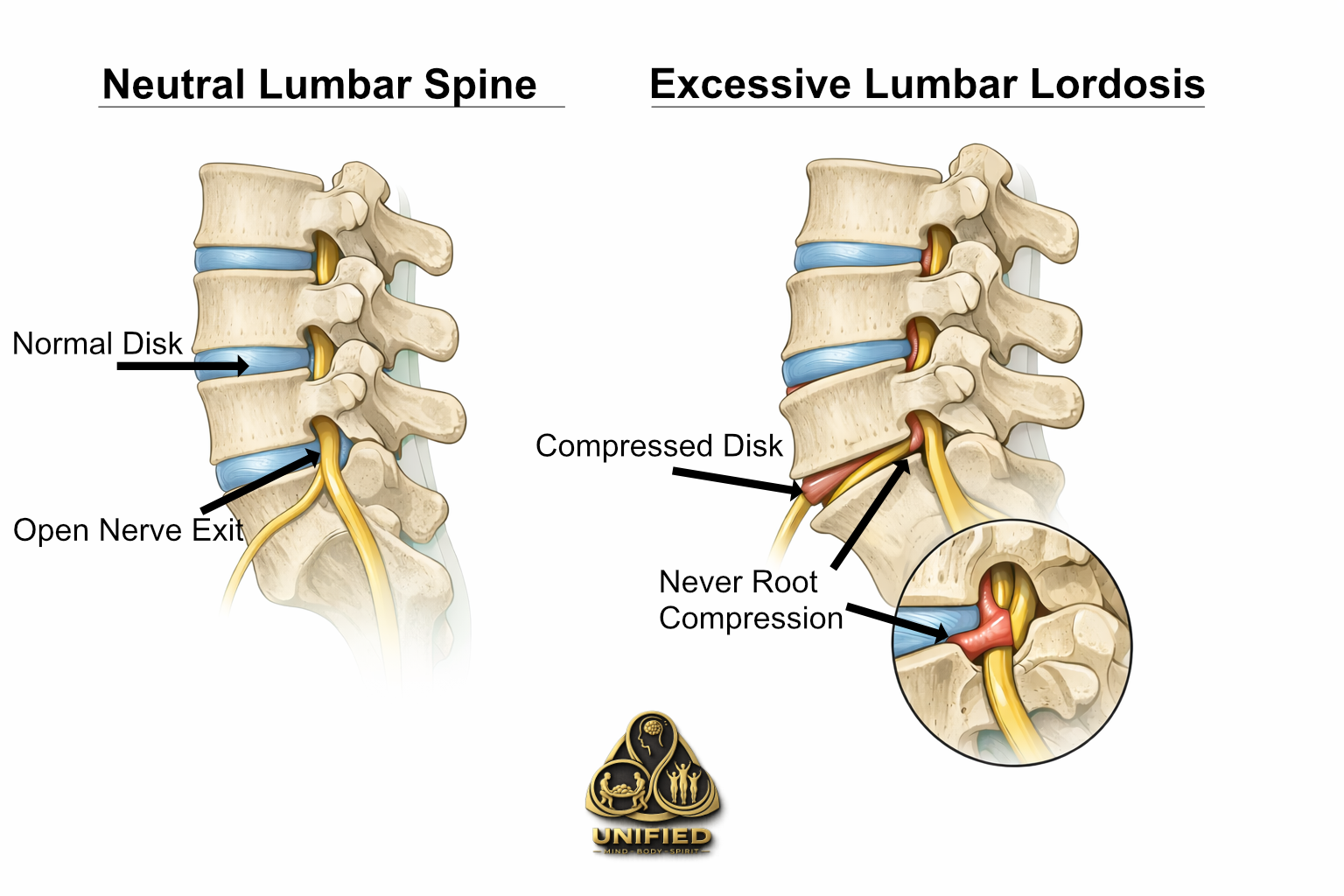 Illustration of the lower spine showing a disc bulge compressing a nerve root, compared with a normal spine.