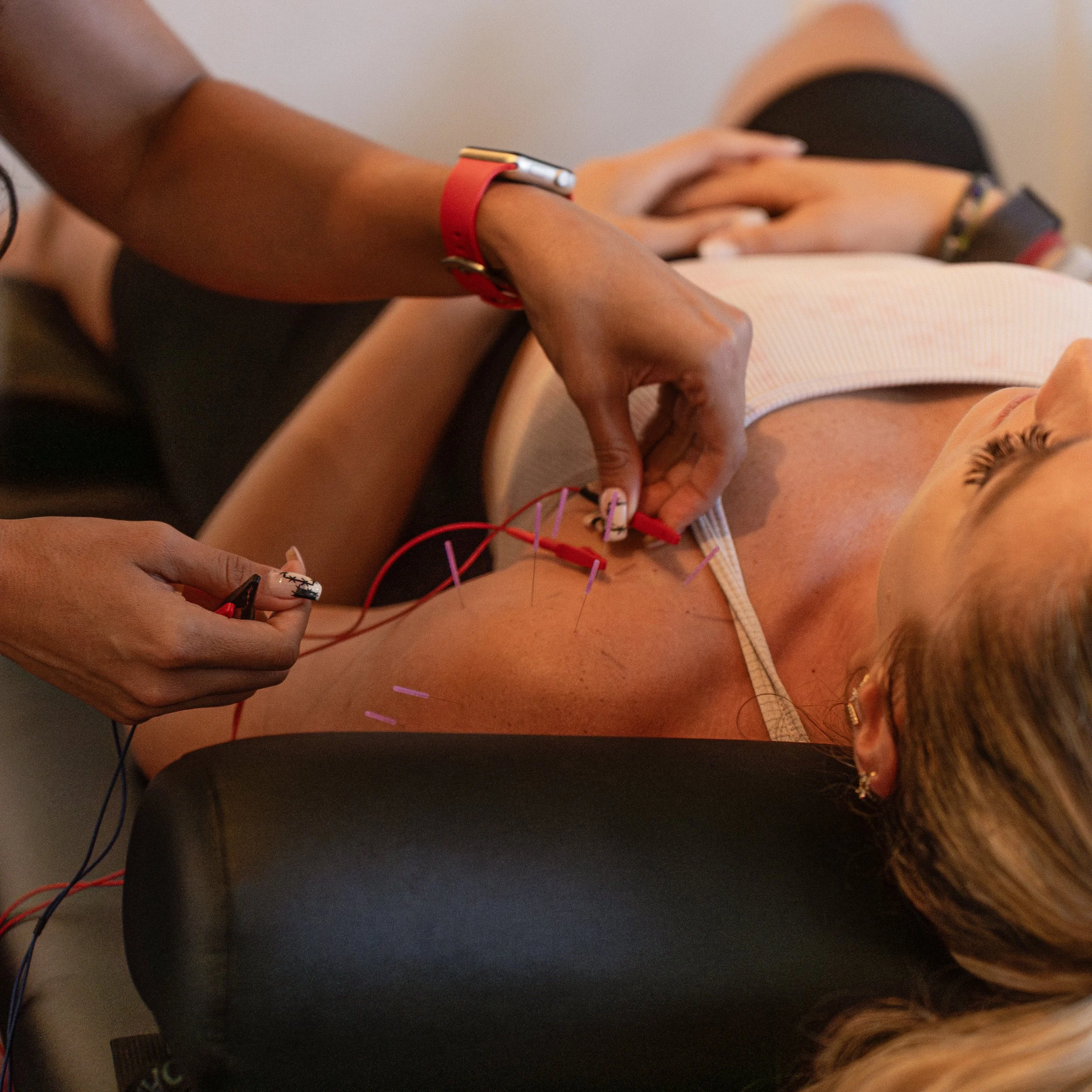 Dry Needling in Miami Beach: What It Is, What It Treats, and What to Expect at Your First Session