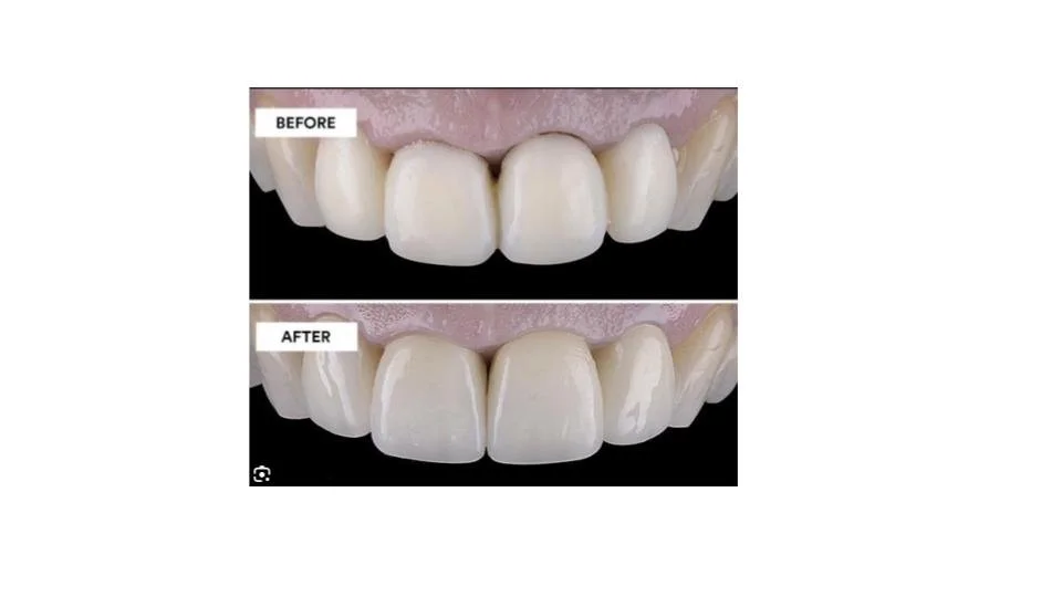 Session 2 - New Age Methodology in Esthetic Dentistry - Filtek Matrix ...
