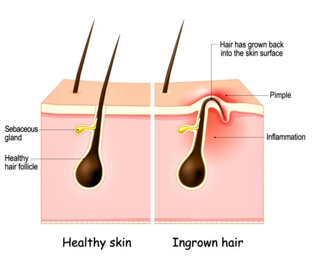 Skin Deep Electrology permanent hair removal services.FDA Approved Electrolysis is the only method of permanent hair removal. Effective for all hair colors, skin tones and ages. Treats ingrown hair. PCOS hirsutism excess body and facial hair.