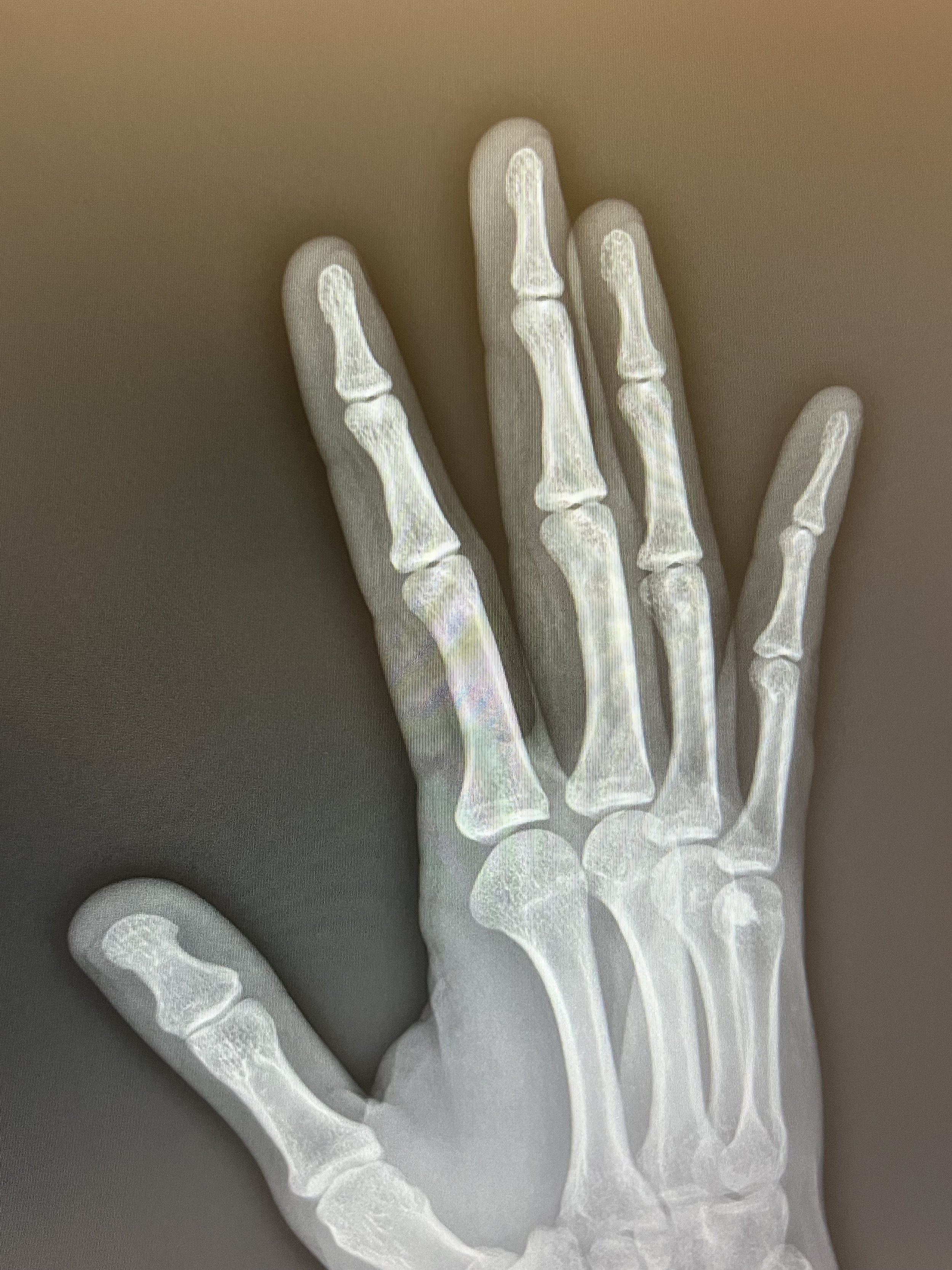 my hand x ray