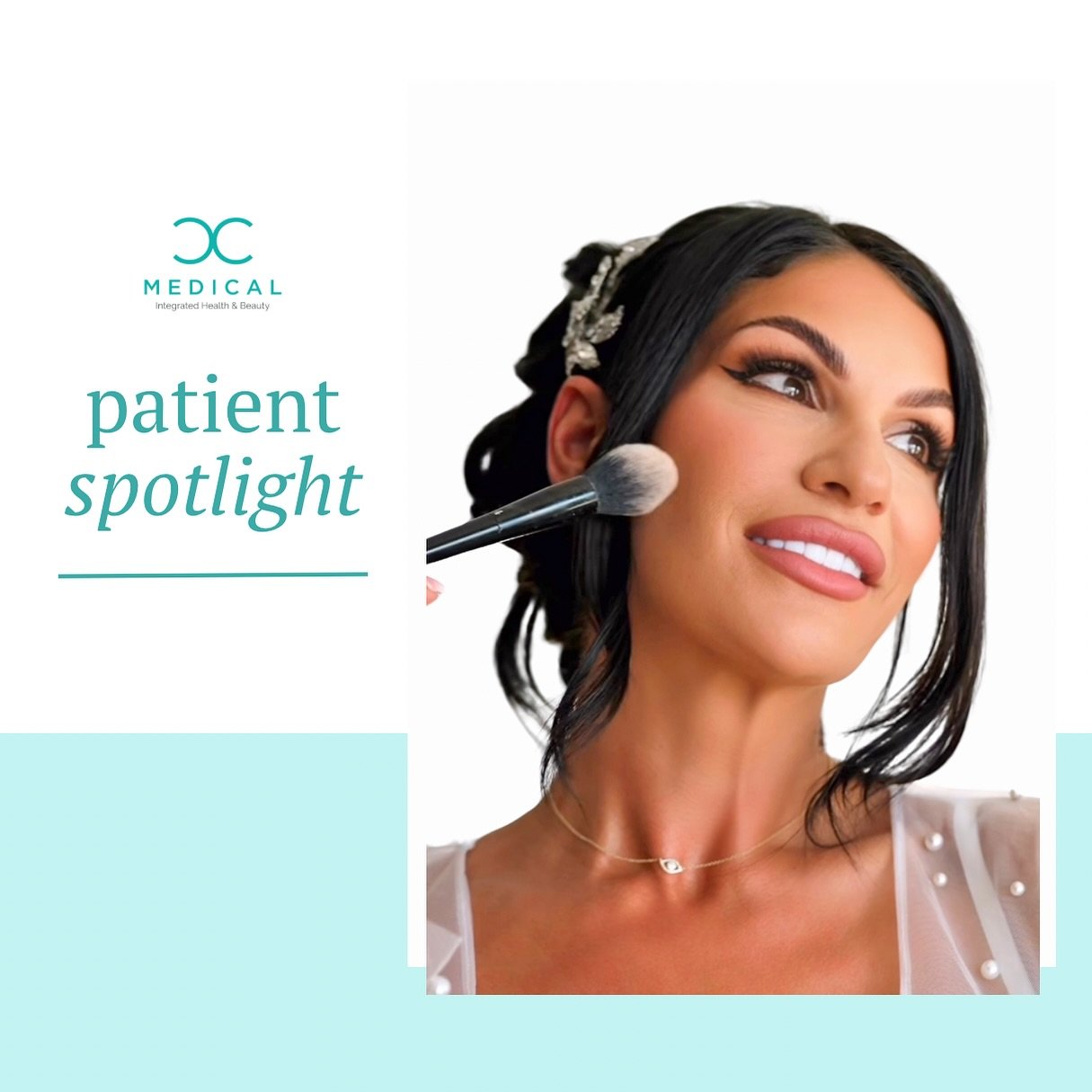 Congratulations to this bridal beauty! ✨💍 Darian came to CC Medical wanting to reduce the appearance of her neck bands and jowls to give her a boost of confidence when smiling in photos on her wedding day. 

By injecting botox in the platysmal bands