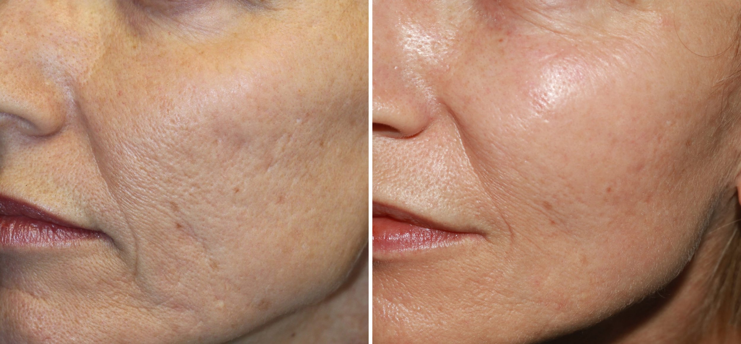 patient-14174-micro-needling-before-after-scaled.jpg
