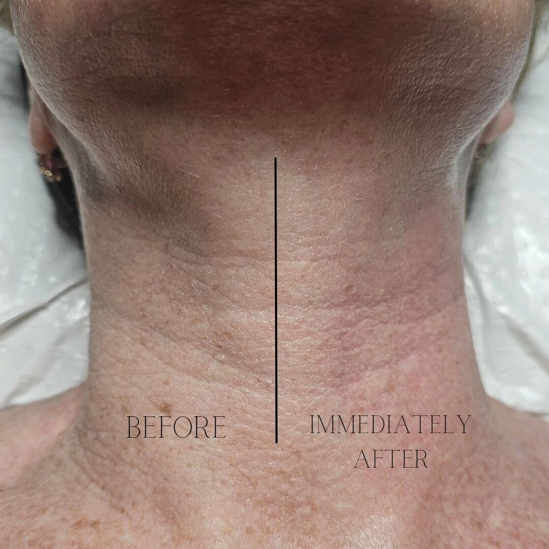 WiQo has an immediate lifting and redesifying effect on the skin, so it appears smoother and firmer instantly.

The results are persistent after a full course (5 sessions @ 7-10 day intervals).

This neck is already less creapy and more tight upon ap