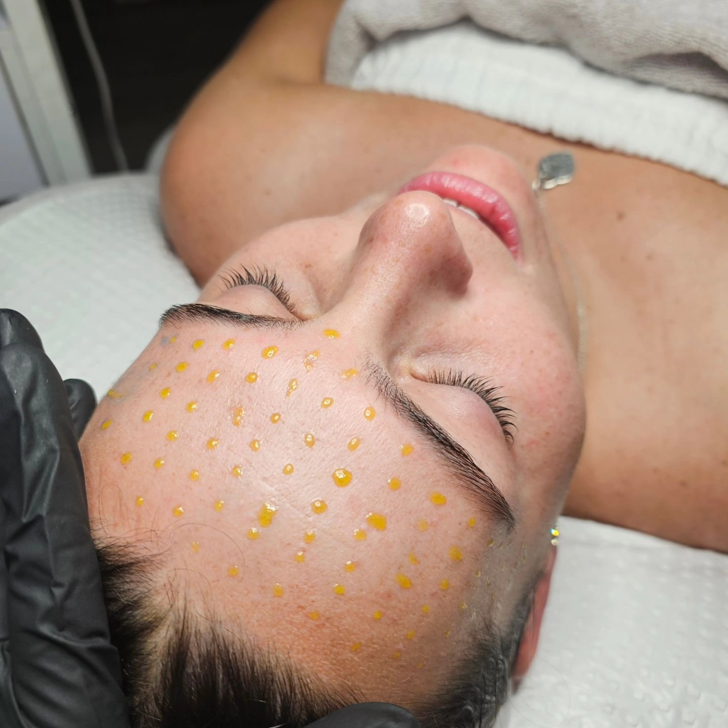 💚 BIOREPEEL is available to book online now! 

Best done as a course of 4/6 treatments at 7/10 day intervals.
(Memberships available)

Treating acne, acne scarring, congestion, enlarged pores, fine lines, wrinkles, pigmentation, and sun damage.

All