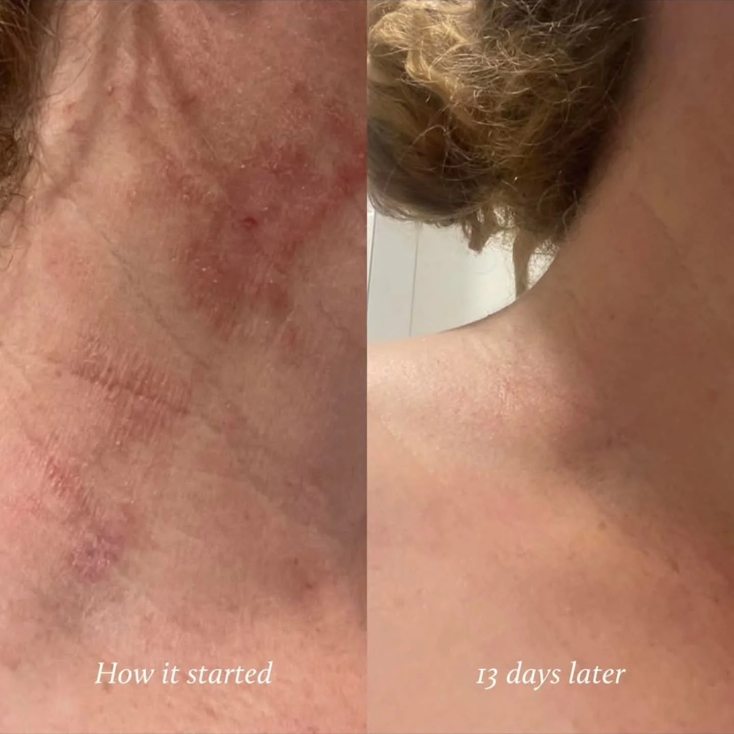 Dermatitis is mainly a barrier problem
The skin suffers with reduced lipids,  making way for increased water loss, coupled with inflammation and itch/ sting.

Glory Oil supports the conditions needed for healing, rather than &ldquo;treating&rdquo; de