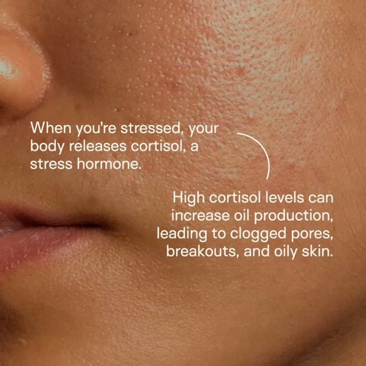 Stress skin isn&rsquo;t just &ldquo;a breakout.&rdquo;
It&rsquo;s a barrier that&rsquo;s been pushed beyond capacity 💔

Elevated cortisol increases oil, fuels inflammation, and weakens your skin&rsquo;s ability to protect and repair itself &mdash; w