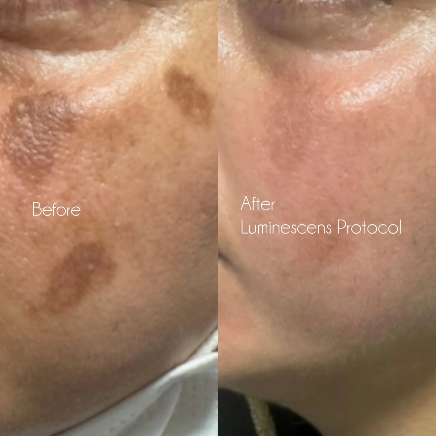Pigment isn't just removed &mdash; it's suppressed.

Luminescens is a clinical depigmentation system designed to regulate overactive melanocytes, reduce excess melanin production and progressively fade visible pigmentation.

By combining targeted in-