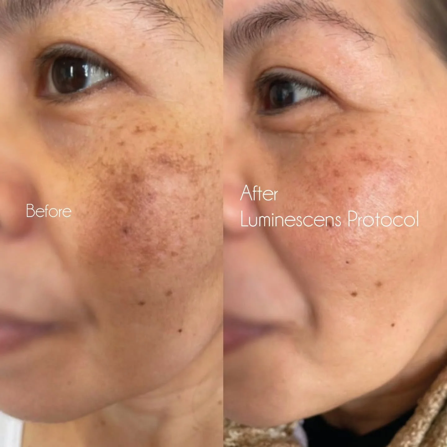 For years, pigment treatment was all about removal.

Peels. Lasers. More aggression.

But in 2026 we understand that pigment is a biological process, not just a surface problem.

Aggressive treatments can create inflammation, disrupt barrier function