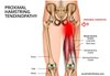 The 6 stages of Proximal Hamstrings Tendinopathy Recovery — Benji Physio