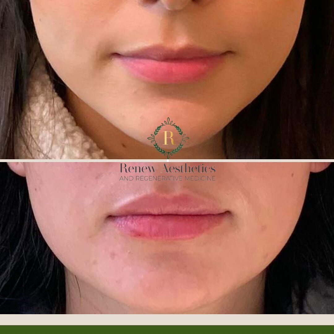 Hitting that hydrated and balanced lips in this bombshell&hellip;

I&rsquo;ve said it once and I&rsquo;ll say it a million more times&hellip;so thankful so have such beautiful canvases within our Renew clientele 💜🌻

Get those lips, cheeks, jawlines