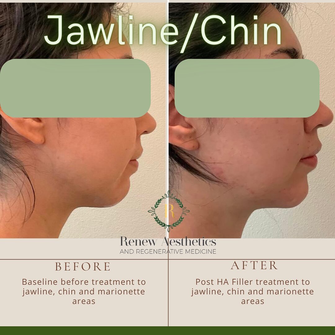 Improving structure and balance is 🔑 to filler placement!

&bull;Addressing the jawline and chin promote a defined and balanced facial profile 
&bull;A recessed chin can negatively affect your overall facial structure: nose, lips, jawline, marionett